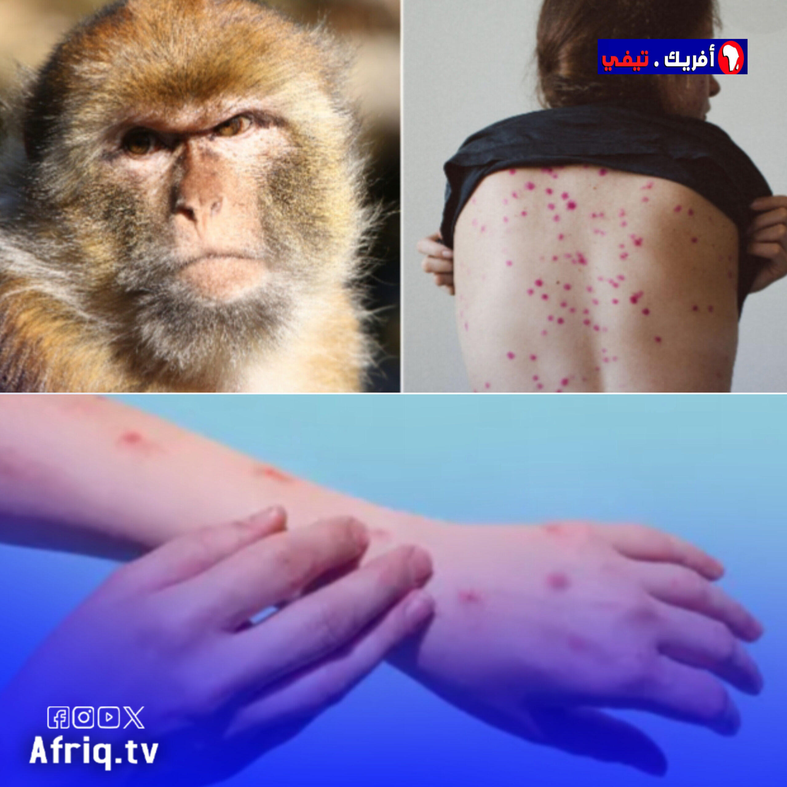 تسجيل 18737حالة إصابة محتملة أو مؤكدة بجدري  في إفريقيا
